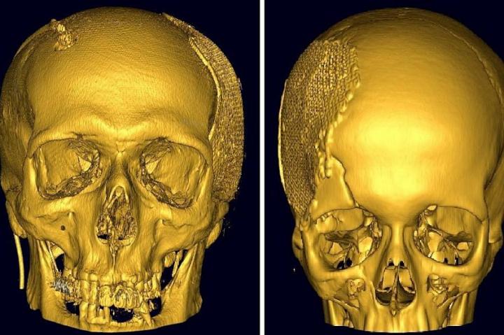 Нейрохирурги разработали имплантат для краниопластики черепа